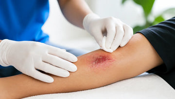 What are the stages of wound healing?